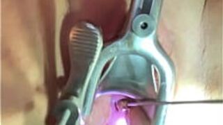 Uterus penetration with rosebud dilator - porn video